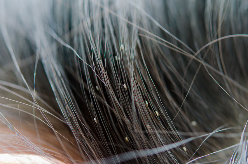 Head Lice Health Risk Head Lice Health Risk