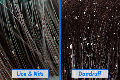 Never Dealt With Head Lice