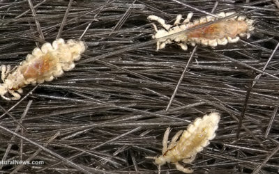 Lice Increase With Covid-19 Pandemic