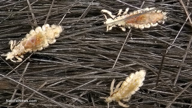 Lice Increase With Covid-19 Pandemic